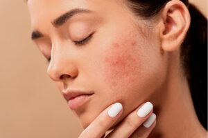 acne, pimples, spot- First Aid Creams.jpg