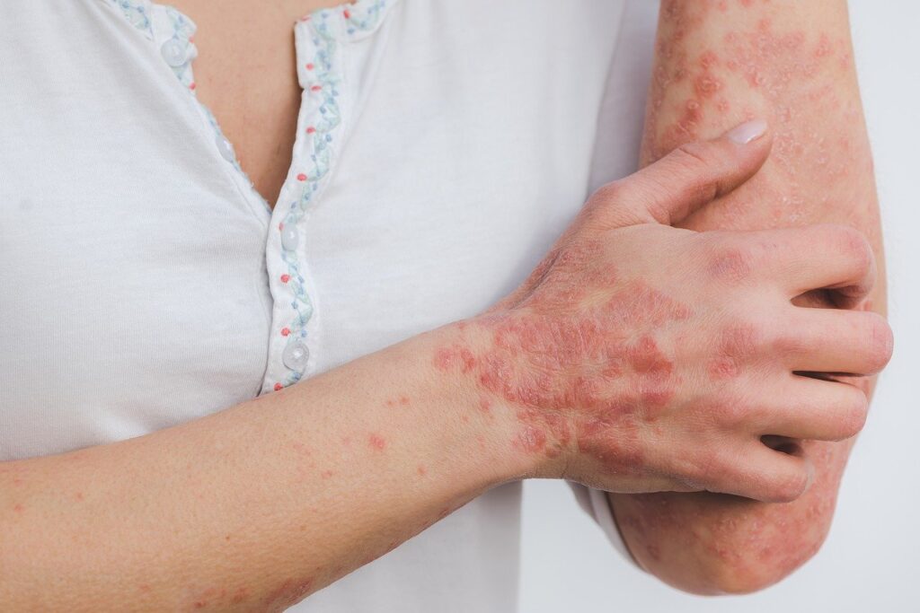 Psoriasis - Atopic skin inflammation - Dermatitis - Acne - Itching Pruritus - Multi-systemic sclerosis - Seborraya - Scrading - Shingles
